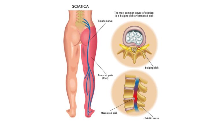 Sciatica treatment in McAllen