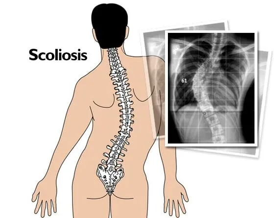 Scoliosis Treatment in McAllen