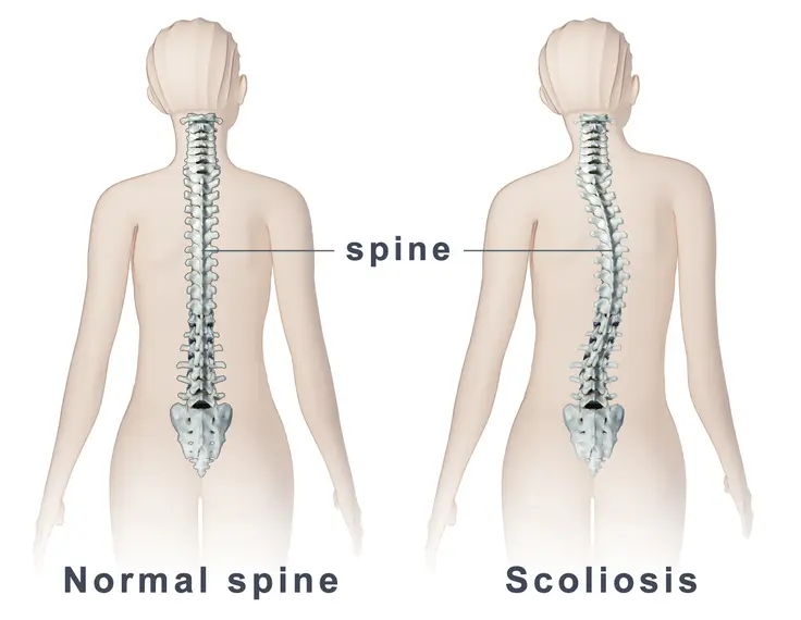 Scoliosis Treatment in McAllen